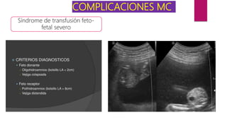 COMPLICACIONES MC
Síndrome de transfusión feto-
fetal severo
 