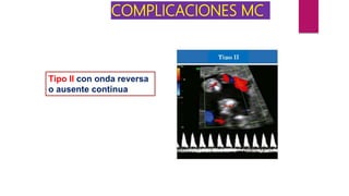 COMPLICACIONES MC
Tipo II con onda reversa
o ausente continua
 