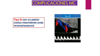 COMPLICACIONES MC
Tipo III con un patrón
cíclico intermitente onda
reversa/ausencia
 