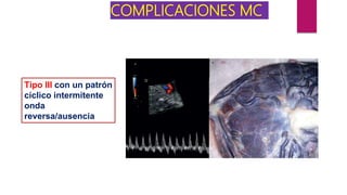 COMPLICACIONES MC
Tipo III con un patrón
cíclico intermitente
onda
reversa/ausencia
 