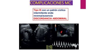 COMPLICACIONES MC
Tipo III con un patrón cíclico
intermitente onda
reversa/ausencia
DISCORDANCIA ABDOMINAL
 