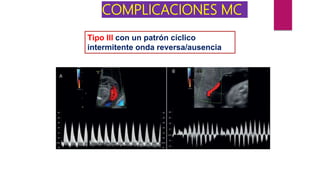 COMPLICACIONES MC
Tipo III con un patrón cíclico
intermitente onda reversa/ausencia
 