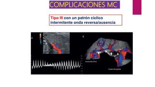 COMPLICACIONES MC
Tipo III con un patrón cíclico
intermitente onda reversa/ausencia
 