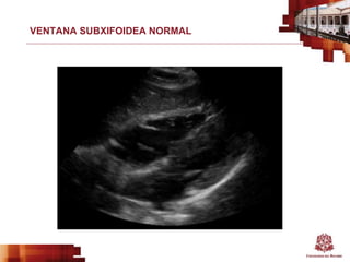 VENTANA SUBXIFOIDEA NORMAL
 