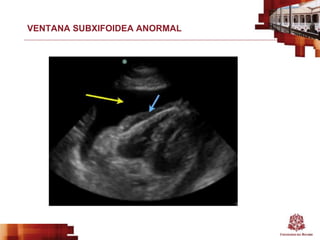 VENTANA SUBXIFOIDEA ANORMAL
 