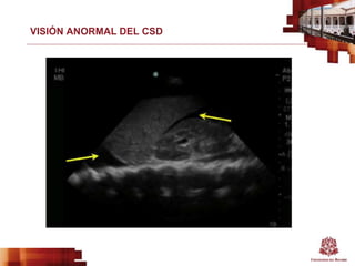 VISIÓN ANORMAL DEL CSD
 