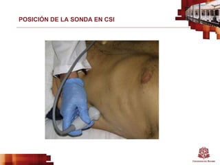POSICIÓN DE LA SONDA EN CSI
 