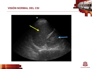 VISIÓN NORMAL DEL CSI
 