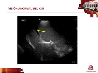 VISIÓN ANORMAL DEL CSI
 