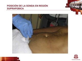 POSICIÓN DE LA SONDA EN REGIÓN
SUPRAPÚBICA
 