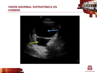 VISIÓN ANORMAL SUPRAPÚBICA EN
HOMBRE
 