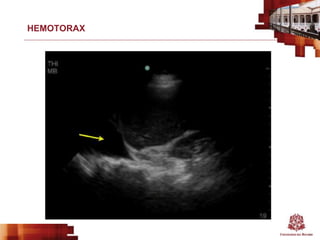 HEMOTORAX
 
