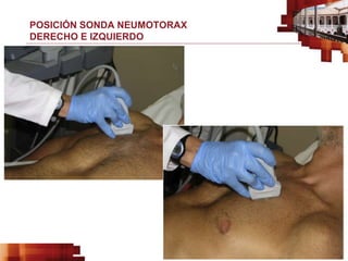 POSICIÓN SONDA NEUMOTORAX
DERECHO E IZQUIERDO
 