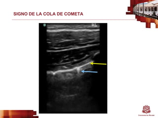 SIGNO DE LA COLA DE COMETA
 