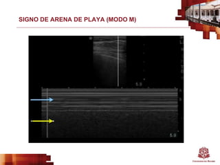 SIGNO DE ARENA DE PLAYA (MODO M)
 