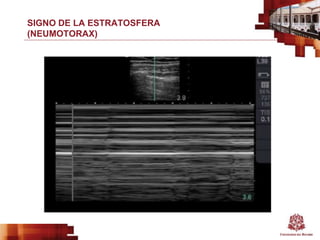 SIGNO DE LA ESTRATOSFERA
(NEUMOTORAX)
 