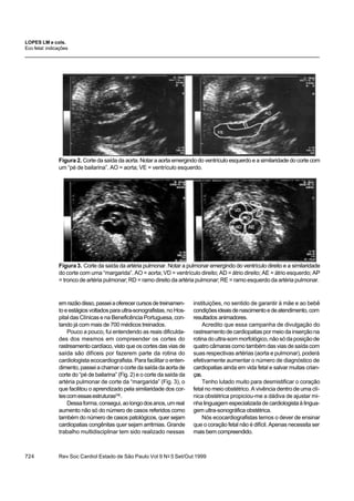 Rev Soc Cardiol Estado de São Paulo Vol 9 No
5 Set/Out 1999724
emrazãodisso,passeiaoferecercursosdetreinamen-
toeestágiosvoltadosparaultra-sonografistas,noHos-
pital das Clínicas e na Beneficência Portuguesa, con-
tando já com mais de 700 médicos treinados.
Pouco a pouco, fui entendendo as reais dificulda-
des dos mesmos em compreender os cortes do
rastreamento cardíaco, visto que os cortes das vias de
saída são difíceis por fazerem parte da rotina do
cardiologista ecocardiografista. Para facilitar o enten-
dimento, passei a chamar o corte da saída da aorta de
corte do “pé de bailarina” (Fig. 2) e o corte da saída da
artéria pulmonar de corte da “margarida” (Fig. 3), o
que facilitou o aprendizado pela similaridade dos cor-
tescomessasestruturas(14)
.
Dessaforma,consegui,aolongodosanos,umreal
aumento não só do número de casos referidos como
também do número de casos patológicos, quer sejam
cardiopatias congênitas quer sejam arritmias. Grande
trabalho multidisciplinar tem sido realizado nessas
Figura 2. Corte da saída da aorta. Notar a aorta emergindo do ventrículo esquerdo e a similaridade do corte com
um “pé de bailarina”. AO = aorta; VE = ventrículo esquerdo.
Figura3. Corte da saída da artéria pulmonar. Notar a pulmonar emergindo do ventrículo direito e a similaridade
do corte com uma “margarida”. AO = aorta; VD = ventrículo direito; AD = átrio direito; AE = átrio esquerdo; AP
= tronco de artéria pulmonar; RD = ramo direito da artéria pulmonar; RE = ramo esquerdo da artéria pulmonar.
instituições, no sentido de garantir à mãe e ao bebê
condiçõesideaisdenascimentoedeatendimento,com
resultados animadores.
Acredito que essa campanha de divulgação do
rastreamentodecardiopatiaspormeiodainserçãona
rotinadoultra-sommorfológico,nãosódaposiçãode
quatro câmaras como também das vias de saída com
suas respectivas artérias (aorta e pulmonar), poderá
efetivamente aumentar o número de diagnóstico de
cardiopatias ainda em vida fetal e salvar muitas crian-
ças.
Tenho lutado muito para desmistificar o coração
fetal no meio obstétrico. A vivência dentro de uma clí-
nica obstétrica propiciou-me a dádiva de ajustar mi-
nha linguagem especializada de cardiologista à lingua-
gem ultra-sonográfica obstétrica.
Nós ecocardiografistas temos o dever de ensinar
que o coração fetal não é difícil. Apenas necessita ser
mais bem compreendido.
LOPES LM e cols.
Eco fetal: indicações
 