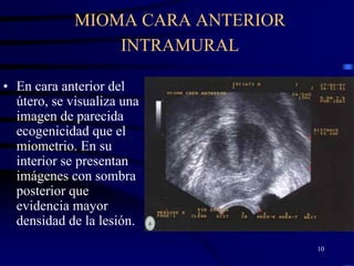 MIOMA CARA ANTERIOR
                 INTRAMURAL

• En cara anterior del
  útero, se visualiza una
  imagen de parecida
  ecogenicidad que el
  miometrio. En su
  interior se presentan
  imágenes con sombra
  posterior que
  evidencia mayor
  densidad de la lesión.
                                   10
 