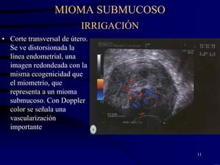 MIOMA SUBMUCOSO
                          IRRIGACIÓN
• Corte transversal de útero.
  Se ve distorsionada la
  línea endometrial, una
  imagen redondeada con la
  misma ecogenicidad que
  el miometrio, que
  representa a un mioma
  submucoso. Con Doppler
  color se señala una
  vascularización
  importante


                                       11
 