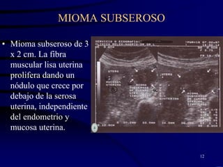 MIOMA SUBSEROSO

• Mioma subseroso de 3
  x 2 cm. La fibra
  muscular lisa uterina
  prolifera dando un
  nódulo que crece por
  debajo de la serosa
  uterina, independiente
  del endometrio y
  mucosa uterina.


                                 12
 