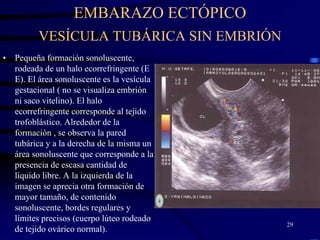 EMBARAZO ECTÓPICO
          VESÍCULA TUBÁRICA SIN EMBRIÓN
•   Pequeña formación sonoluscente,
    rodeada de un halo ecorrefringente (E
    E). El área sonoluscente es la vesícula
    gestacional ( no se visualiza embrión
    ni saco vitelino). El halo
    ecorrefringente corresponde al tejido
    trofoblástico. Alrededor de la
    formación , se observa la pared
    tubárica y a la derecha de la misma un
    área sonoluscente que corresponde a la
    presencia de escasa cantidad de
    líquido libre. A la izquierda de la
    imagen se aprecia otra formación de
    mayor tamaño, de contenido
    sonoluscente, bordes regulares y
    límites precisos (cuerpo lúteo rodeado
                                              29
    de tejido ovárico normal).
 