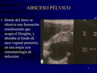 ABSCESO PÉLVICO

• Detrás del útero se
  observa una formación
  sonoluscente que
  ocupa el Douglas, y
  abomba el fondo de
  saco vaginal posterior,
  en una mujer con
  sintomatología de
  infección.

                                  6
 