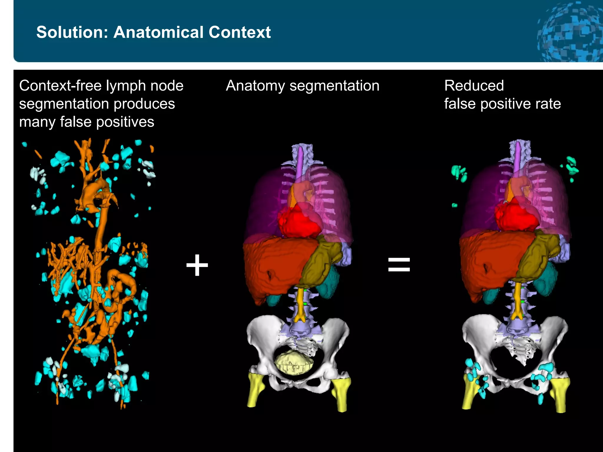 Solution: Anatomical Context Anatomy segmentation Context-free lymph node  segmentation produces many false positives Reduced false positive rate + = 
