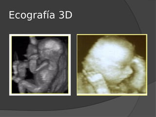 Ecografía 3D
 