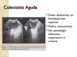 Colecistitis AgudaColecistitis Aguda
Dolor abdominal, en
hemiabdomen
superior.
Fiebre, Leucocitosis
No semiología
infecciosa
respiratoria ni
urinaria
 