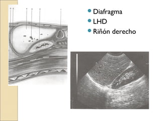 Diafragma
LHD
Riñón derecho
 