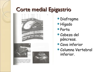 Corte medial EpigastrioCorte medial Epigastrio
Diafragma
Hígado
Porta
Cabeza del
páncreas.
Cava inferior
Columna Vertebral
inferior.
 
