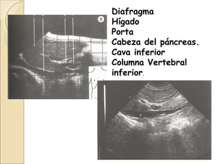 Diafragma
Hígado
Porta
Cabeza del páncreas.
Cava inferior
Columna Vertebral
inferior.
 