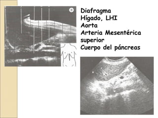 Diafragma
Hígado, LHI
Aorta
Arteria Mesentérica
superior
Cuerpo del páncreas
 