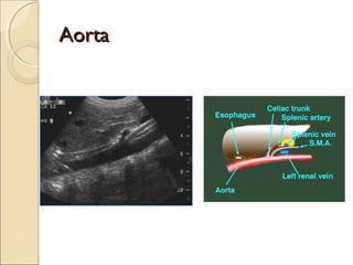 AortaAorta
 