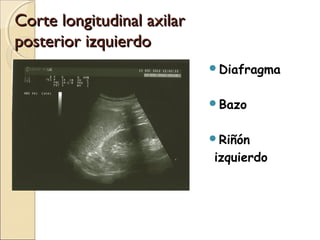 Corte longitudinal axilarCorte longitudinal axilar
posterior izquierdoposterior izquierdo
Diafragma
Bazo
Riñón
izquierdo
 