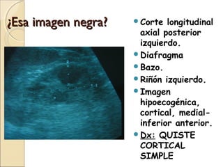 ¿Esa imagen negra?¿Esa imagen negra? Corte longitudinal
axial posterior
izquierdo.
Diafragma
Bazo.
Riñón izquierdo.
Imagen
hipoecogénica,
cortical, medial-
inferior anterior.
Dx: QUISTE
CORTICAL
SIMPLE
 