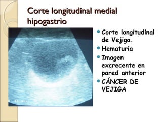 Corte longitudinal medialCorte longitudinal medial
hipogastriohipogastrio
Corte longitudinal
de Vejiga.
Hematuria
Imagen
excrecente en
pared anterior
CÁNCER DE
VEJIGA
 