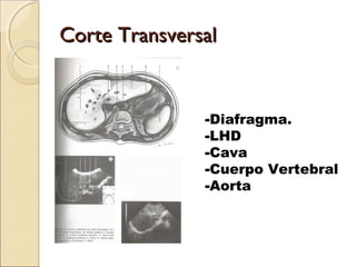 Corte TransversalCorte Transversal
-Diafragma.
-LHD
-Cava
-Cuerpo Vertebral
-Aorta
 