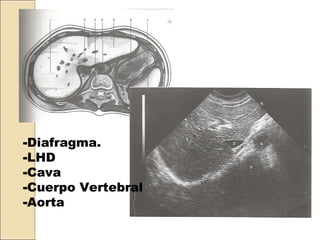 -Diafragma.
-LHD
-Cava
-Cuerpo Vertebral
-Aorta
 