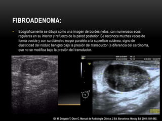 FIBROADENOMA:
• Ecográficamente se dibuja como una imagen de bordes netos, con numerosos ecos
regulares en su interior y refuerzo de la pared posterior. Se reconoce muchas veces de
forma ovoide y con su diámetro mayor paralelo a la superficie cutánea, signo de
elasticidad del nódulo benigno bajo la presión del transductor (a diferencia del carcinoma,
que no se modifica bajo la presión del transductor.
Gil M, Delgado T, Oton C. Manual de Radiología Clínica. 2 Ed. Barcelona: Mosby Ed. 2001: 581-592.
 