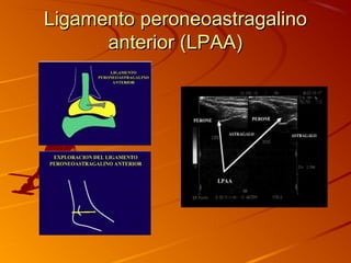 Ligamento peroneoastragalinoLigamento peroneoastragalino
anterior (LPAA)anterior (LPAA)
 