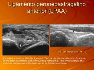 Ligamento peroneoastragalinoLigamento peroneoastragalino
anterior (LPAA)anterior (LPAA)
Lado contralateral normalLado contralateral normal
Ruptured anterior talofibular ligament. Thick arrow denotes the site of rupture,
at the talar attachment with surrounding hematoma. Thin arrows denote the
more normal portion of the ligament at its fibular attachment.
 