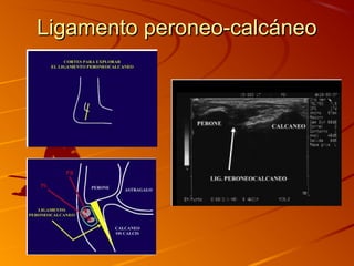 Ligamento peroneo-calcáneoLigamento peroneo-calcáneo
 