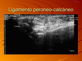 Ligamento peroneo-calcáneoLigamento peroneo-calcáneo
 