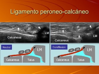 Ligamento peroneo-calcáneoLigamento peroneo-calcáneo
 
