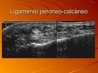 Ligamento peroneo-calcáneoLigamento peroneo-calcáneo
 