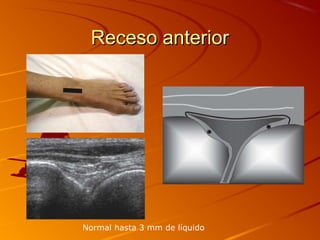 Receso anteriorReceso anterior
Normal hasta 3 mm de líquido
 