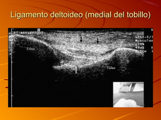 Ligamento deltoideo (medial del tobillo)Ligamento deltoideo (medial del tobillo)
 