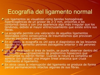 Ecografía del ligamento normal
Los ligamentos se visualizan como bandas homogéneas
hiperecogénicas de un grosor de 2-3 mm, próximas a los
contornos óseos y con una apariencia algo más irregular que los
tendones, debido al mayor entrecruzamiento que existe entre sus
fibras.
La ecografía permite una valoración de aquellos ligamentos
lesionados como consecuencia de traumatismos que provocan
roturas parciales o completas.
En el tobillo la ecografía es útil para el diagnóstico de las lesiones
agudas del ligamento peroneo astragalino anterior y del peroneo
calcáneo
Una vez localizado el área de lesión, se puede observar dentro del
ligamento un engrosamiento de predominio hipoecoico que
interrumpe su patrón fibrilar. Cuando la rotura es completa se
aprecia con claridad una imagen lineal anecoica que cruza
totalmente el ligamento.
En otros casos la interrupción del ligamento se produce de forma
parcial permaneciendo intactas algunas de sus fibras.
 