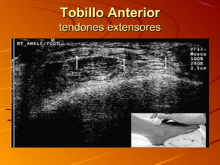 Tobillo AnteriorTobillo Anterior
tendones extensorestendones extensores
 